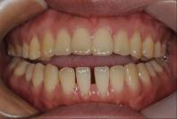 Canting correction A. Facial asymmetry and occlusal canting B.