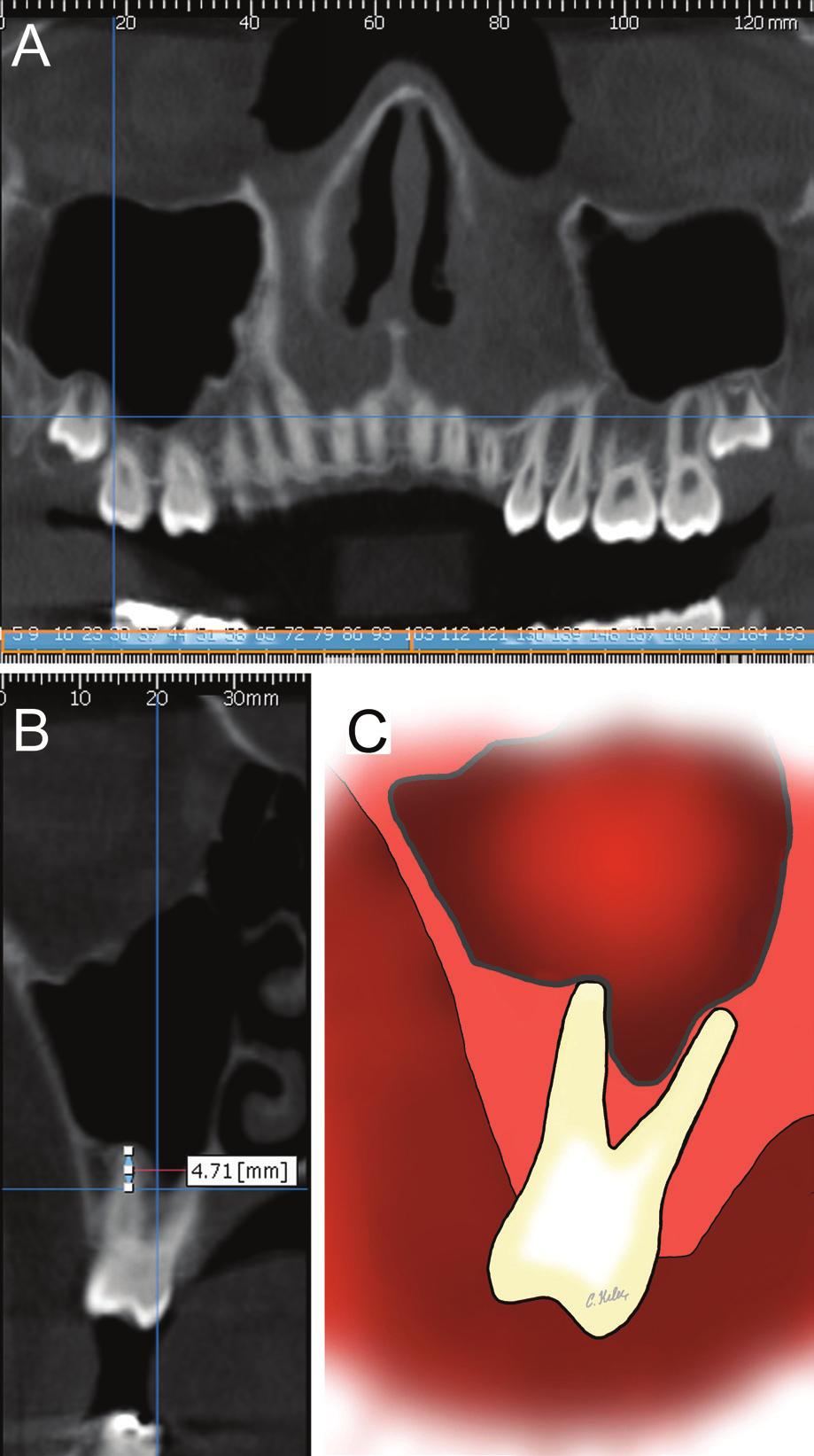 Maxillary sinus floor and posterior teeth Group 2 were given negative numbers and those in Group 3 were given positive numbers.