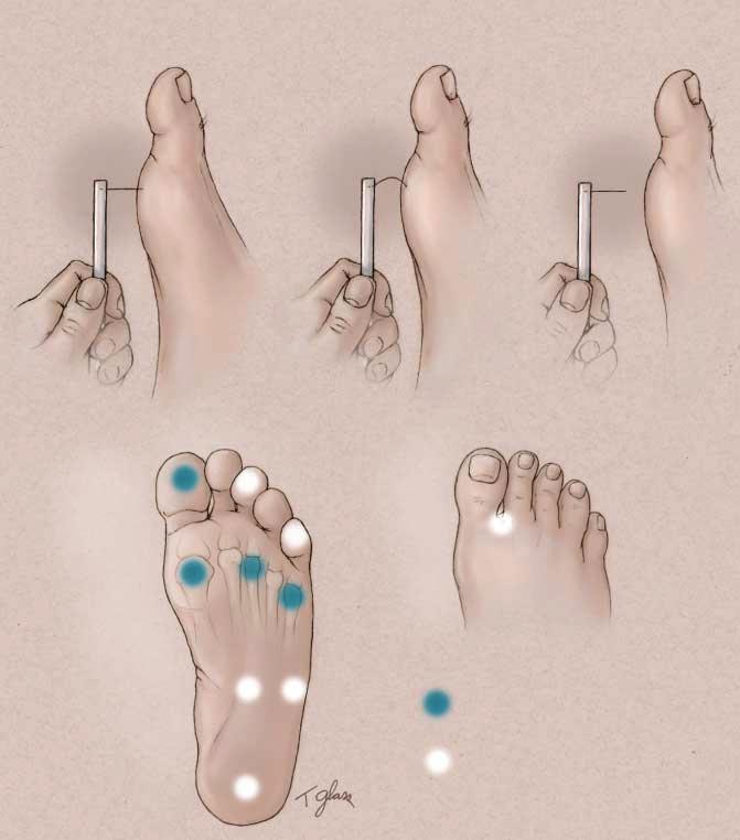 While authorities recommend testing 8 to 10 anatomic sites, testing just 4 plantar sites on the forefoot (great toe and base of first, third, and fifth metatarsals) identifies 90% of patients with an