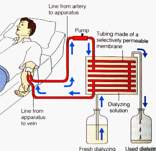 Renal Failure & Artificial Kidney Symptoms when < 25% functional nephrons Hemodialysis: 3/week 4-8h/session