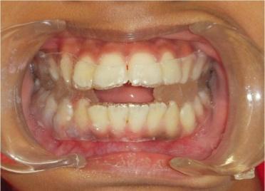 degrees Minimal or no crowding or spacing present Overjet of 5 10 mm Subjects with a history of orthodontic treatment, anterior open bite, severe proclination of anterior teeth, or any systemic