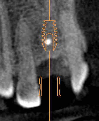6. Preventing planning errors Collision between drill sleeve and neighboring tooth Figure 3 shows the collision between a drill sleeve and a neighboring tooth.