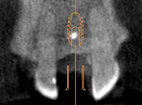 Collision between drill sleeve and gingiva Figure 4 shows the collision between a drill sleeve and the gingiva. If you reflect a gingival flap during surgery, this will not be a problem.