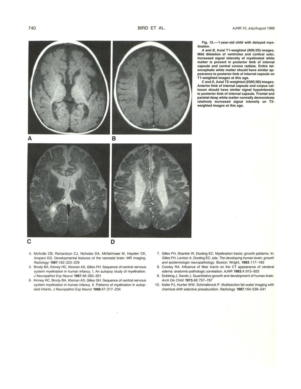 74 IRD ET L. JNR:1, July/ugust 1989 Fig. 13.-1-year-old child with delayed myelination. and 8, xial T1-weighted (6/2) images. Mild dilatation of ventricles and cortical sulci.