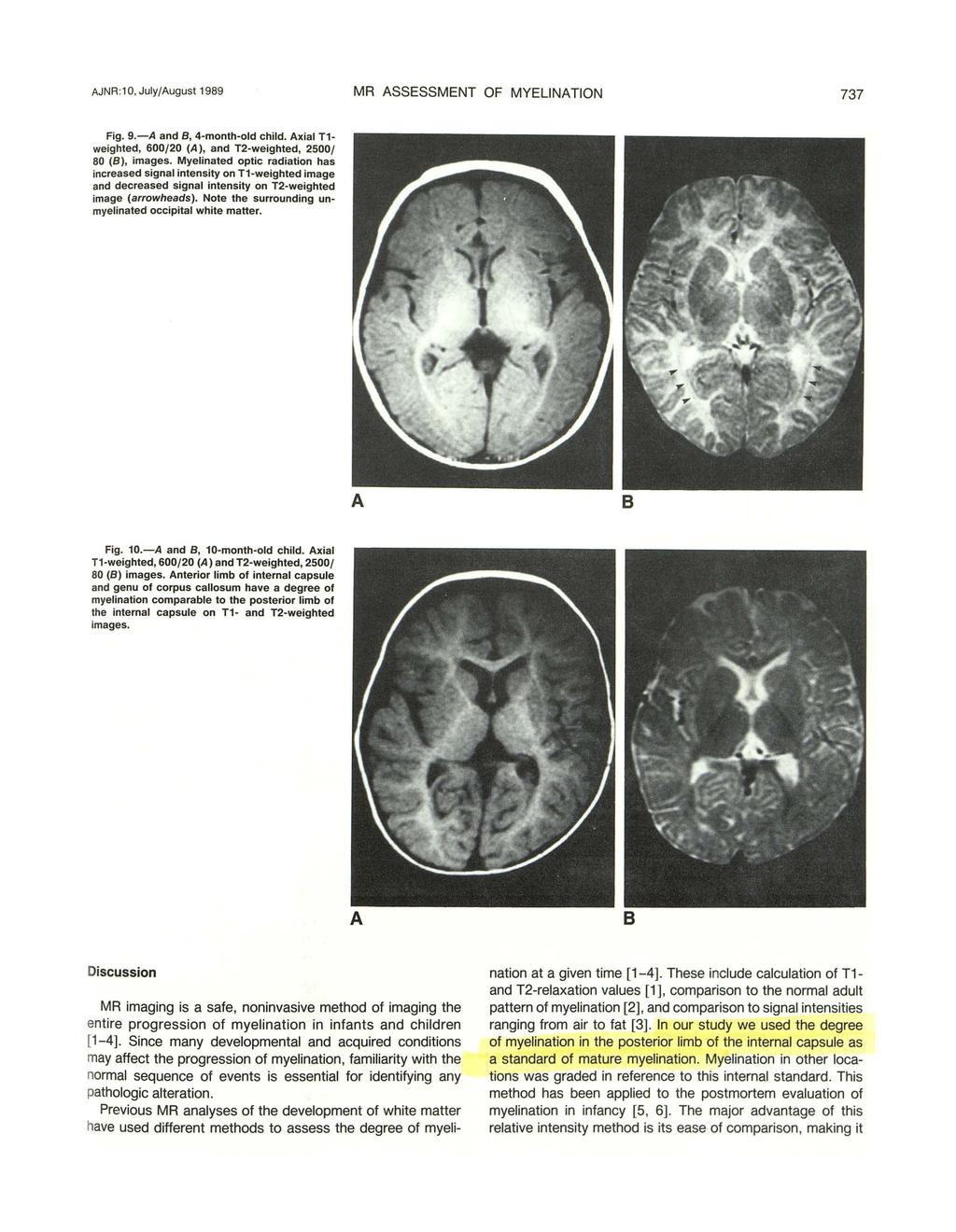 JNR :1, July/ugust 1989 MR SSESSMENT OF MYELINTION 737 Fig. 9.- and, 4-month-old child. xial T1- weighted, 6/2 (), and T2-weighted, 25/ 8 (), images.