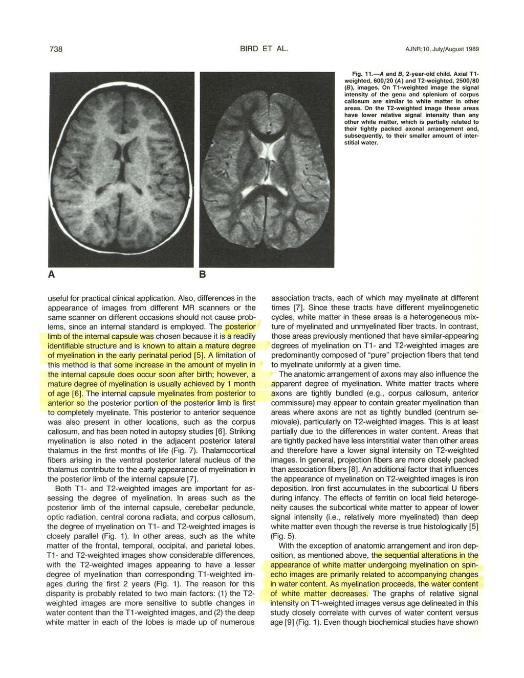 738 IRD ET L. JNR:1, July/ugust 1989 Fig. 11.- and, 2-year-old child. xial T1- weighted, 6/2 () and T2-weighted, 25/8 (8), images.