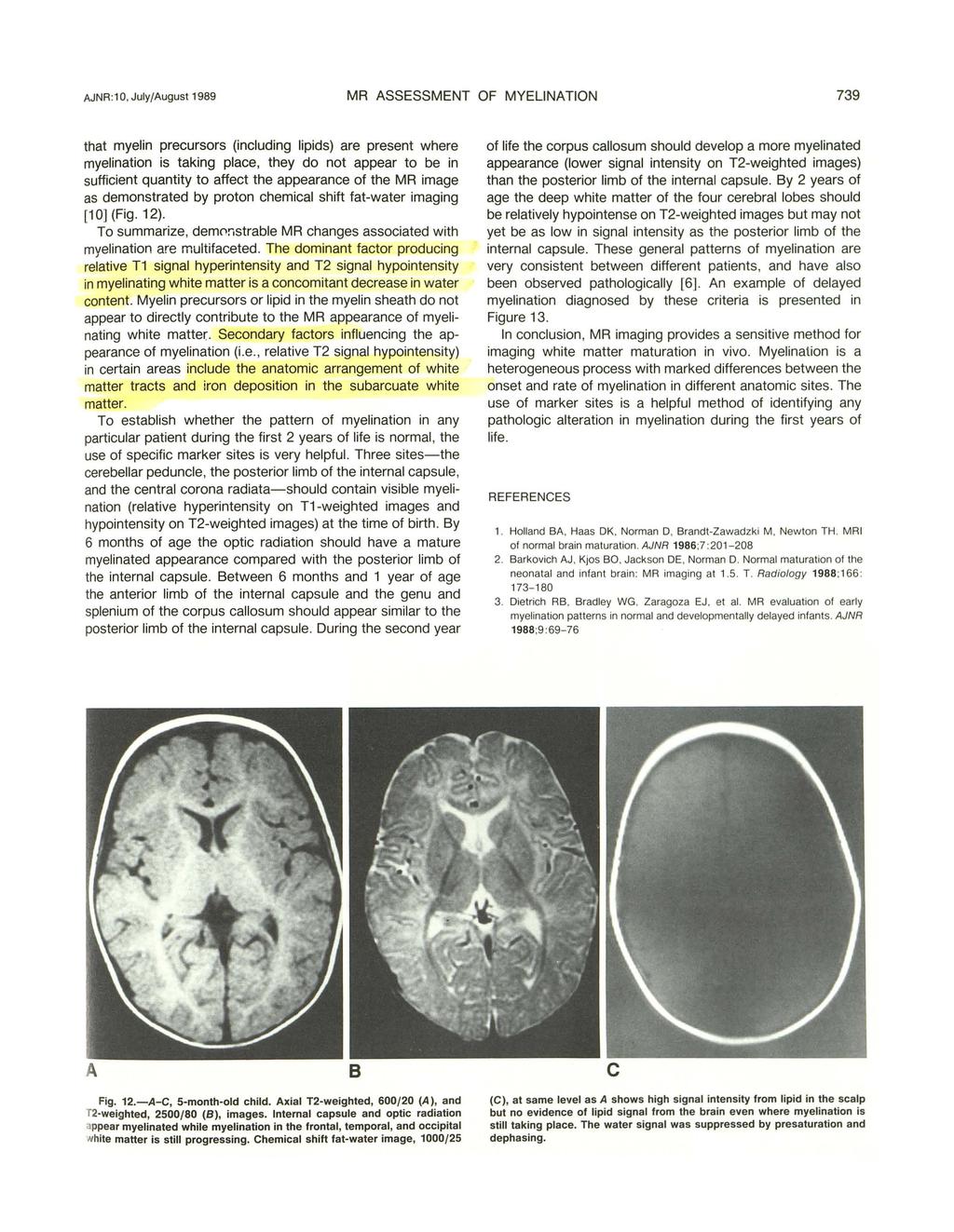 JNR :1, July/ugust 1989 MR SSESSMENT OF MYELINTION 739 that myelin precursors (including lipids) are present where myelination is taking place, they do not appear to be in sufficient quantity to