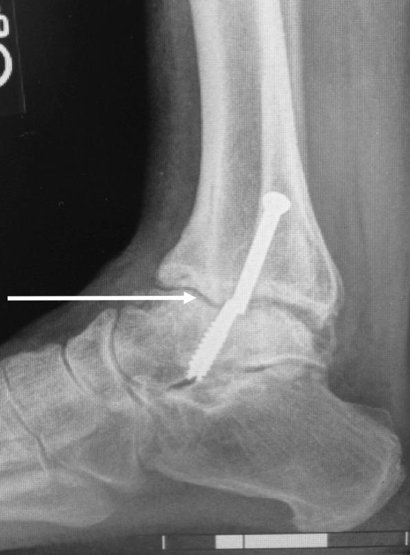 Pre-operative Figure 1: Pre-operative right lateral ankle