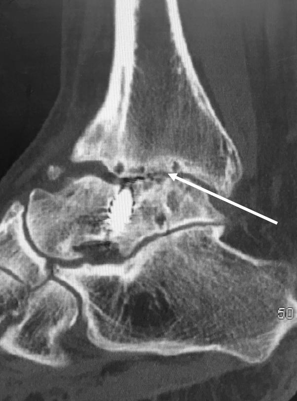 showing nonunion at the ankle, broken  Figure 3: