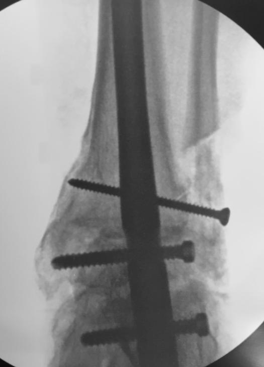 Ankle Nonunions Immediate post-operative Figure 5: Immediate