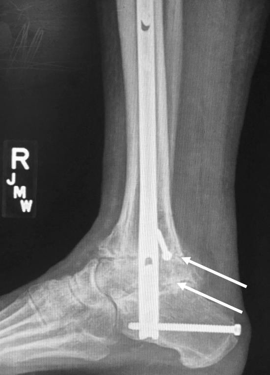 x-ray shows excellent position  3-month post-operative Figure 7:
