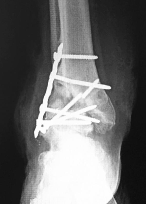Pre-operative Figure 1: Pre-operative right anteroposterior ankle