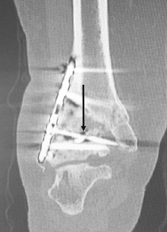 nonunion at the ankle (arrow), broken hardware, bone loss, 