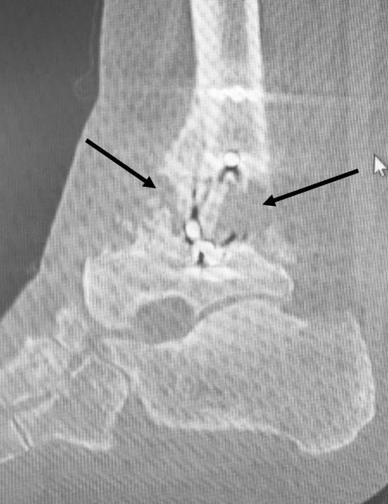incorporation of the allograft, and complete nonunion (arrow).