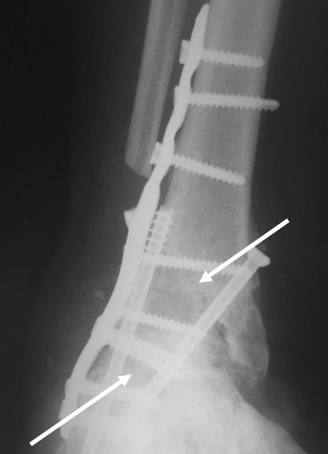 position, void filling (arrow), and  3-month post-operative Figure 7: