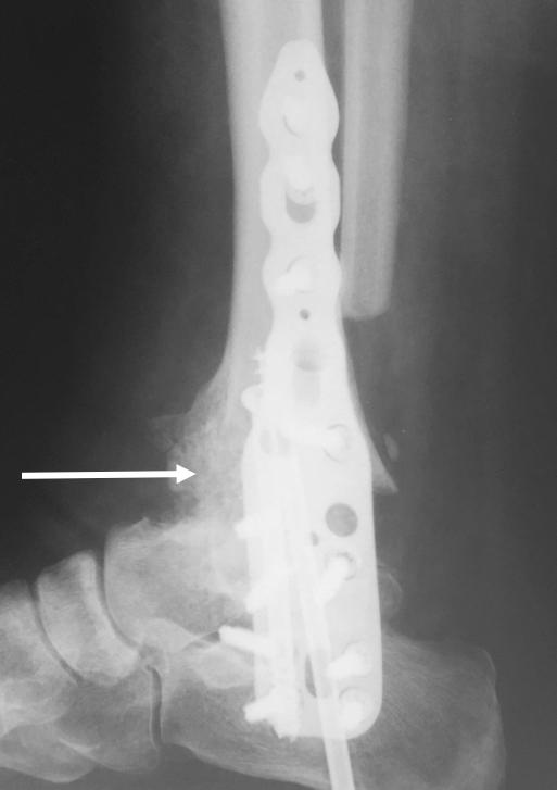 consolidation at subtalar and ankle. The arrows indicate bone fusion.