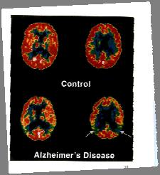Alzheimer s disease PET scans in AD Most common form of dementia-