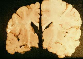 Symmetrical cortical atrophy temporal and parietal lobes.