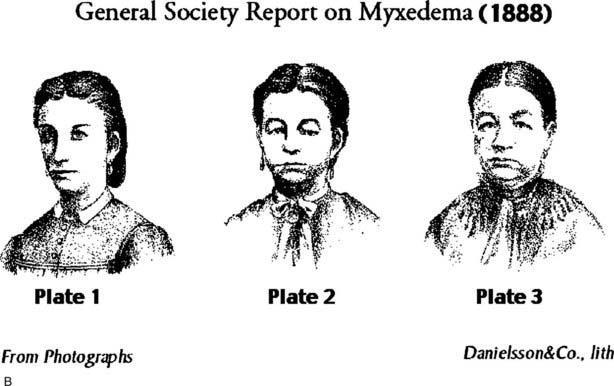 Hypothyroidism and Neuropsychiatric Symptoms Psychosis Mood Cognition 1888 Committee on Myxedema of the Clinical 50% Society of
