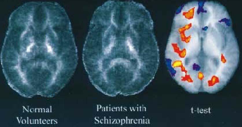 Frontal area in schizophrenia (Buchsbaum, Tang et al. 1998) Decreased in schizophrenia Buchsbaum, Tang et al. (1998): statistical mapping Lim, Hedehus et al.