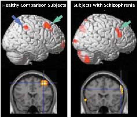 Schizophrenia Evidence of reduced connectivity functional imaging studies functional disconnection between frontal and posterior