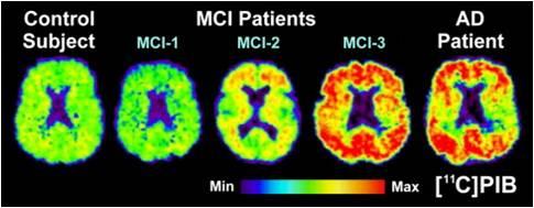 PiB-PET Scans: AD vs MCI vs control From the online newspaper of Prof Yasser Metwally
