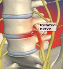 Radiculopathy Nerve root impingement with typical pain radiation and/or motor or sensory impairment leading to nerve root dysfunction.