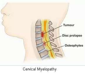 Myelopathy Compression or stretching of the spinal cord can cause myelopathy, which is more common in the cervical rather than the thoracic spine. Hyperreflexia and positive Babinski sign are common.