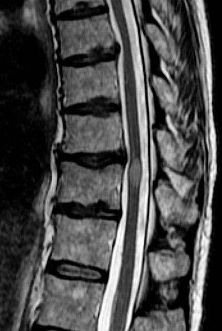 Localized demyelination of the spinal cord. Is caused by an immune process resulting in small vessel vasculopathy, ischemia, and demyelination.