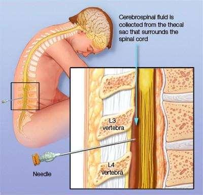 Definition: The procedure of taking CSF from the spine in the lower back