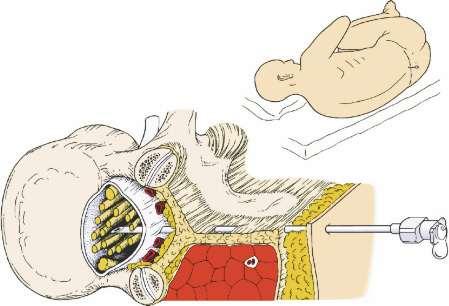 The patient should lie flat on his side with the back at the edge of the bed. Flexion of hips and knees is done.