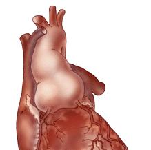 MFS Cardiovascular Features Aortic Aneurysm (>65%) Mitral valve prolapse(~40% by 30 years of age) * Cardiomyopathy(One report of 25% have reduced EF in absence of significant valvularregurgitation or