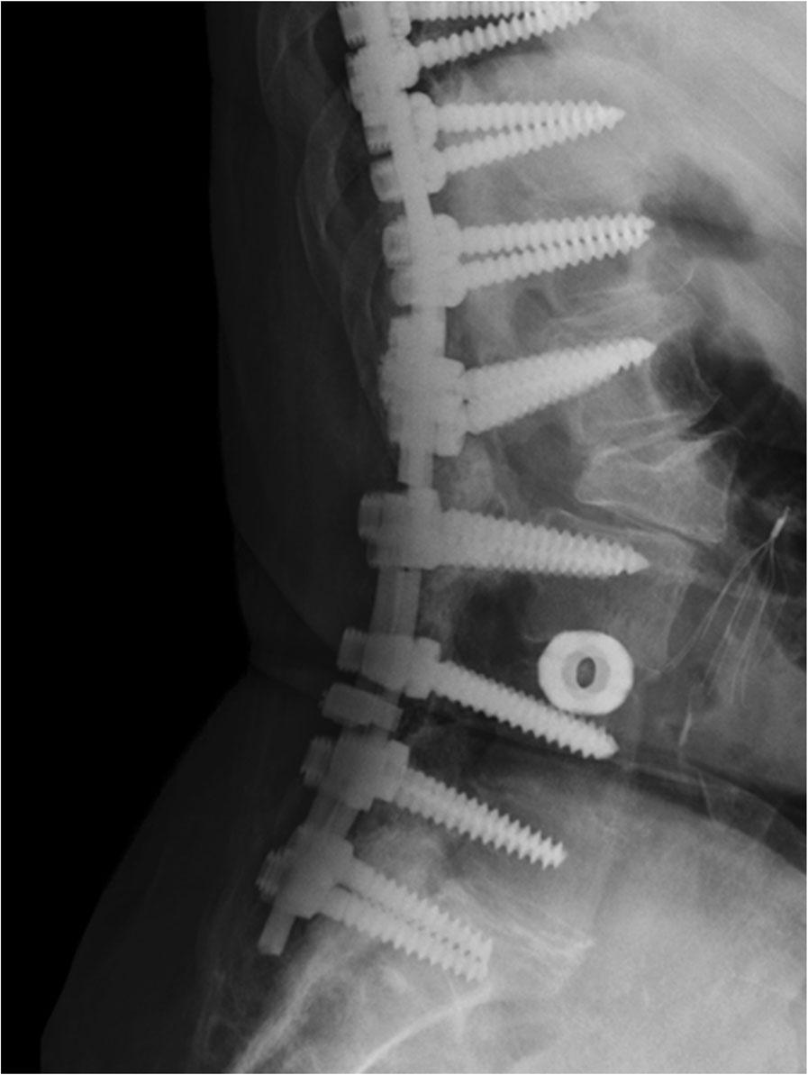 Kavadi et al. Scoliosis and Spinal Disorders (2017) 12:19 Page 4 of 7 Fig.