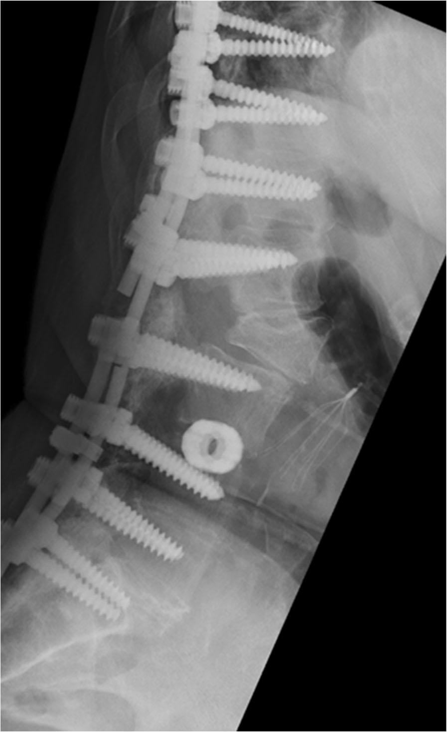 All patients who demonstrated implant failure at the level of osteotomy were between 6 and 12 months post surgery. Symptomatic rod failure occurred at 24 months in a patient with L5 S1 failure.