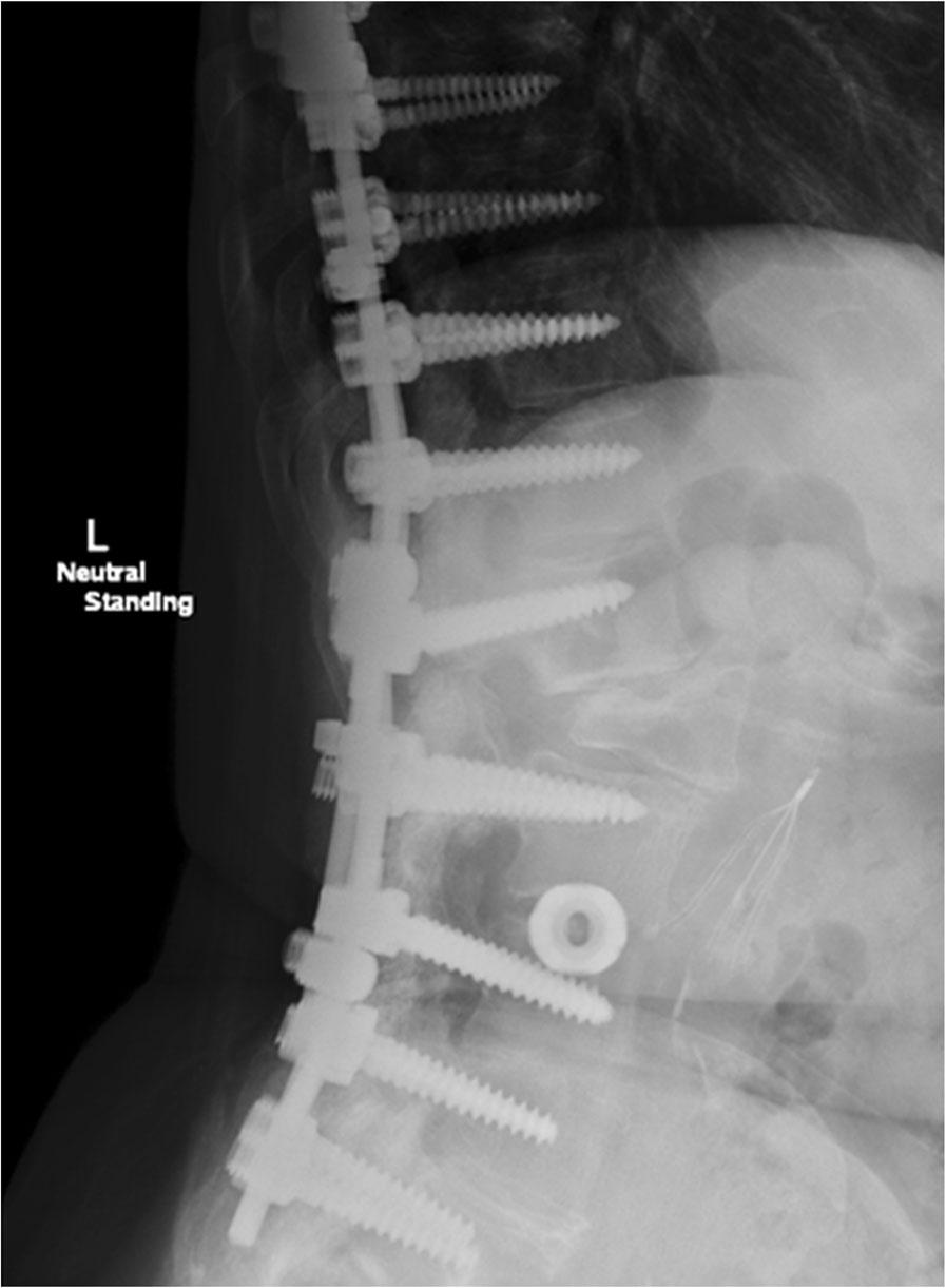 Finally, an apex of the new spinal curvature will be located at the osteotomy site, and maximum stress borne by the implants and maximum rod contouring at this point compounded by high notch
