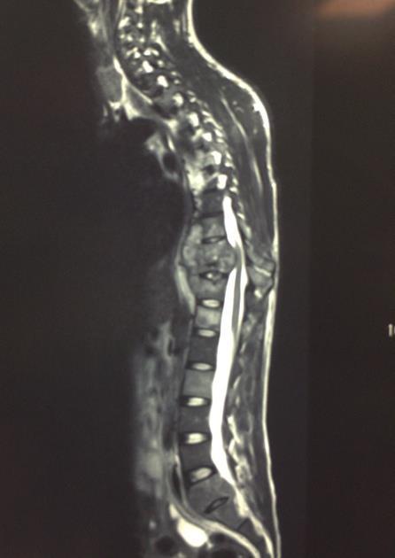 radiologic-clinical correction were shown. PSO and posterior spinal instrumentation/ fixation T8-L1 done.