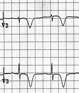 Wellens syndrome Deeply-inverted or biphasic T waves in V2-3 (may extend to