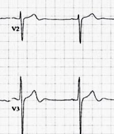 waves Preserved precordial R wave progression Recent history of angina ECG