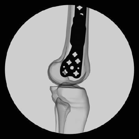 Because the shaft of the femur is frequently out of alignment with the distal fragment, proper plate placement can be determined by orienting the