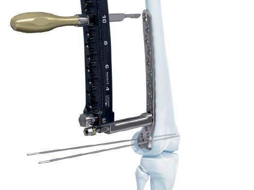 Insert Plate Optional instrument 03.120.016 Scalpel Handle Attach a #11 blade to the scalpel handle.