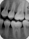 (a) (b) (c) Fig. 5. Teeth segmentation. (a) Original image; (b) Result of top-hat enhancement. (c) Morphological operation.