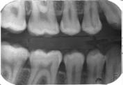 In spite the fact that wavelet based segmentation and classification has achieved superior results, when dealing with dental images it was not very successful or meaningful.