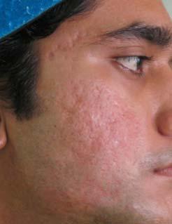 In general we can state, that all types of acne scars are improved after Dermaroller needling. This young 28 years old male is a typical case of rolling acne scars.