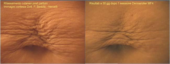Lax skin responds very well to Dermarolling. Recommended model: MF8, 1.5 mm SEQUENCE OF TREATMENTS: The sequence and intervals of CIT treatments mainly depend on the client s skin condition.