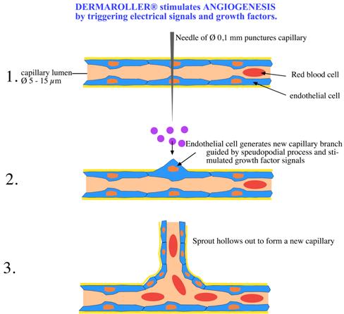 Dermaroller models used: MF8 and MS4 Neo-Angiogenesis can only be logically explained when non-differentiated endothelial cells proliferate and new capillary sprouts migrate into the