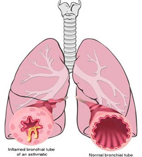 Morphology of Asthma Morphology of Asthma: the pathologic findings are similar in both types BA Grossly: - lung over distended (over inflation), occlusion