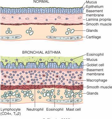 Morphology of Asthma Morphology of Asthma Histologic finding: Thick Basement Membrane. Edema and inflammatory infiltrate in bronchial wall.