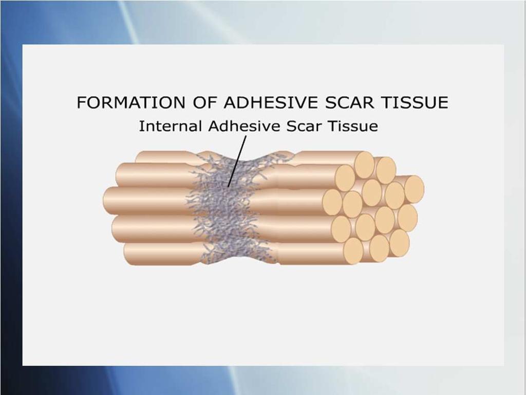 How Friction Therapy Works Breaks down poorly formed scar tissue and prevents its return