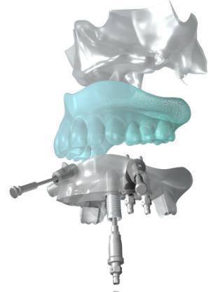 Computerized Guide Templates Dental implants can be placed in the correct