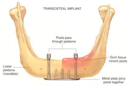 Transosteal (staple) Implants Designed primarily to anchor dentures in the completely edentulous patient These